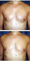 Dr. Allen Rezai, MD, London Plastic Surgeon - Before And After Male Breast Reduction Surgery (6)