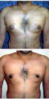 Dr. Allen Rezai, MD, London Plastic Surgeon - Before And After Male Breast Reduction Surgery (7)