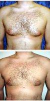 Dr. Allen Rezai, MD, London Plastic Surgeon - Before And After Male Breast Reduction Surgery (8)