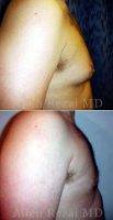 Dr. Allen Rezai, MD, London Plastic Surgeon - Before And After Male Breast Reduction Surgery (9)