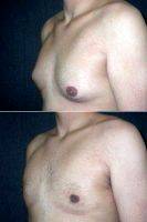 Dr. Andres Taleisnik, MD, Orange County Plastic Surgeon 22 Year Old Male Underwent Male Breast Reduction
