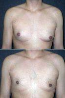 Dr. Andres Taleisnik, MD, Orange County Plastic Surgeon- 22 Year Old Male Underwent Male Breast Reduction