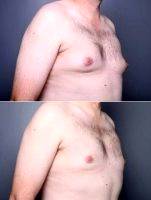 Dr. Angela Keen, MD, Salt Lake City Plastic Surgeon - Male Breast Reduction