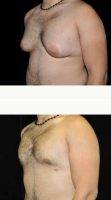 Dr. Brian Vassar Heil, MD, Pittsburgh Plastic Surgeon Male Breast Reduction Before After