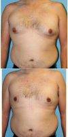 Dr. Bryan C. McIntosh, MD, Bellevue Plastic Surgeon 42 Year Old Man Treated With Male Breast Reduction
