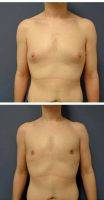 Dr. Chad Robbins, MD, Nashville Plastic Surgeon - 25-34 Year Old Man Treated With Male Breast Reduction