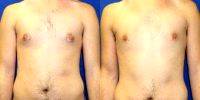 Dr. Clay Forsberg, MD, Scottsdale Plastic Surgeon 24yo, Liposuction For Gynecomastia Before And After (2)