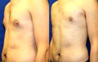 Dr. Clay Forsberg, MD, Scottsdale Plastic Surgeon 24yo, Liposuction For Gynecomastia Before And After (3)