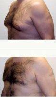 Dr. Cynthia L. Mizgala, MD, Metairie Plastic Surgeon 38 Year Old Man Treated With Male Breast Reduction