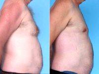 Dr. Dan Mills, MD, Orange County Plastic Surgeon 48 Year Old Male Treated For Gynecomastia With Liposuction Pictures (1)