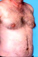 Dr. Dan Mills, MD, Orange County Plastic Surgeon 48 Year Old Male Treated For Gynecomastia With Liposuction Pictures (2)
