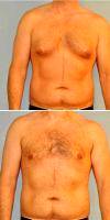 Dr. David F. Pratt, MD, Kirkland Plastic Surgeon 32 Year Old Man Treated With Male Breast Reduction Before After