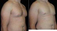 Dr. Don W. Griffin, MD, Nashville Plastic Surgeon 23 Year Old Man Treated With Male Breast Reduction