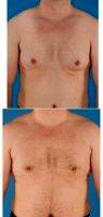 Dr. Elena Prousskaia Peregudova, FRCS (Plast), London Plastic Surgeon 35-44 Year Old Man Treated With Male Breast Reduction