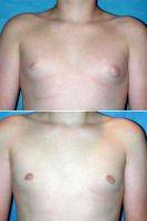 Dr. Frank Barone, MD, Toledo Plastic Surgeon Male Breast Reduction