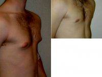 Dr. Franklin D. Richards, MD, Bethesda Plastic Surgeon 25 Year Old Male With Gynecomastia Male Breast Enlargement