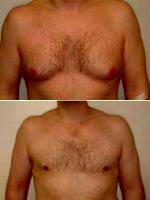 Dr. Franklin D. Richards, MD, Bethesda Plastic Surgeon - 27 Year Old Male With Large Breasts
