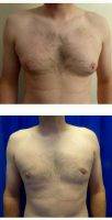 Dr. Giorgio Netri, MBBS, Manchester Plastic Surgeon Male Breast Reduction (3)