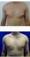 Dr. Giorgio Netri, MBBS, Manchester Plastic Surgeon Male Breast Reduction (8)