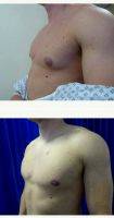 Dr. Giorgio Netri, MBBS, Manchester Plastic Surgeon Male Breast Reduction (9)