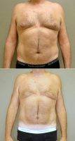 Dr. Gordon Lewis, MD, Midlothian Plastic Surgeon 61 Year Old Male, Liposuction Treatment Of Breasts (1)