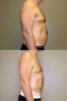 Dr. Gordon Lewis, MD, Midlothian Plastic Surgeon 61 Year Old Male, Liposuction Treatment Of Breasts (2)
