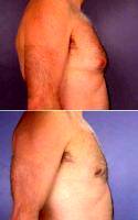 Dr. Grant Stevens, MD, Los Angeles Plastic Surgeon Male Breast Reduction Before After