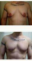 Dr. Gregory Greco, DO, Red Bank Plastic Surgeon 20 Year Old Man Treated With Male Breast Reduction