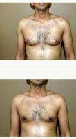 Dr. Gregory Turowski, MD, PhD, FACS, Chicago Plastic Surgeon 25-34 Year Old Man Treated With Male Breast Reduction