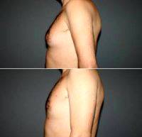 Dr. Ioannis Gkotsikas, MD, Greece Plastic Surgeon 30 Year Old Man Treated With Male Breast Reduction