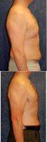 Dr. James A. Hoffman - 42 Year Old Man Treated With Male Breast Reduction And Liposuction Of Waistline