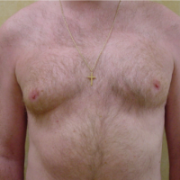 Dr. James Murphy, FRCS(Plast), Manchester Plastic Surgeon Male Breast Reduction