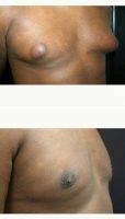 Dr. John Michael Thomassen, MD, Fort Lauderdale Plastic Surgeon 19 Year Old Man Treated With Male Breast Reduction