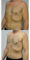 Dr. Jonathan Hall, MD, Boston Plastic Surgeon 25-34 Year Old Man Treated With Male Breast Reduction