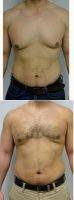 Dr. Jonathan Hall, MD, Boston Plastic Surgeon 25 Year Old Man Treated With Male Breast Reduction