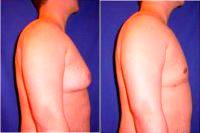 Dr. Joseph Poggi, MD, Wichita Plastic Surgeon Male Breast Reduction