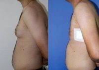 Dr. Kamran Efendioglu, MD, Turkey Plastic Surgeon 27 Year Old Male Gynecomastia Before And After (1)