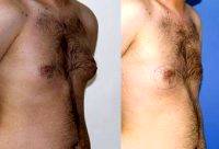 Dr. Kamran Efendioglu, MD, Turkey Plastic Surgeon 27 Year Old Male Gynecomastia Before And After (2)