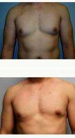 Dr. Leo Lapuerta, MD, Houston Plastic Surgeon 35-44 Year Old Man Treated With Male Breast Reduction