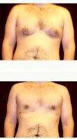 Dr. Matthew H. Steele, MD, Sioux City Plastic Surgeon 25-34 Year Old Man Treated With Male Breast Reduction