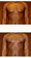Dr. Matthew H. Steele, MD, Sioux City Plastic Surgeon 25 Year Old Man Treated With Male Breast Reduction