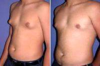 Dr. Max Polo, MD, Miami Plastic Surgeon Gynecomastia Male Breast Reduction