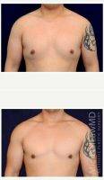 Dr. Michael Law, MD, Raleigh-Durham Plastic Surgeon 25 Year Old Man Treated With Male Breast Reduction