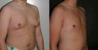 Dr. Otto Joseph Placik, MD, Chicago Plastic Surgeon Male Breast Reduction