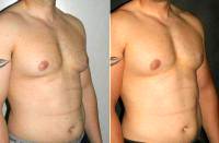 Dr. Otto Joseph Placik, MD, Chicago Plastic Surgeon Male Breast Reduction