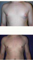 Dr. Richard Zienowicz, MD, Providence Plastic Surgeon 25-34 Year Old Man Treated With Male Breast Reduction