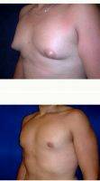 Dr. Richard Zienowicz, MD, Providence Plastic Surgeon 25-34 Year Old Man Treated With Male Breast Reduction Before After