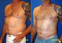 Dr. Sam Gershenbaum, DO, Aventura Plastic Surgeon Male Breast Reduction