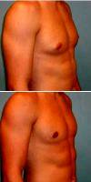 Dr. Sean T. Lille, MD, Scottsdale Plastic Surgeon 18-24 Year Old Man Treated With Gynecomastia Reduction
