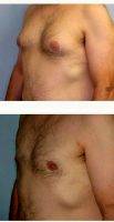 Dr. Sean T. Lille, MD, Scottsdale Plastic Surgeon 25-34 Year Old Man Treated With Male Breast Reduction